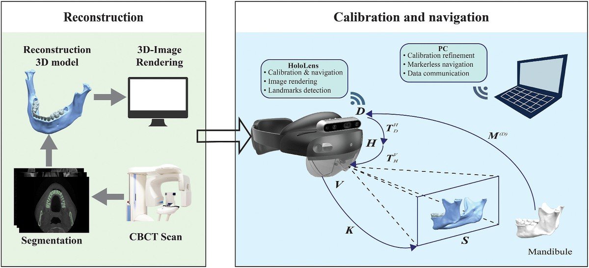 Pipeline for AR-assisted dental treatment: CBCT scan and segmentation produce a reconstructed 3D mandible model, which a HoloLens headset and PC use for markerless calibration and navigation.